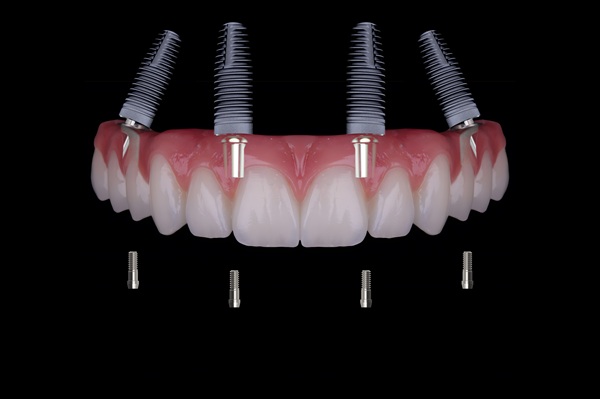 Smile Makeover Treatment: All On  ®