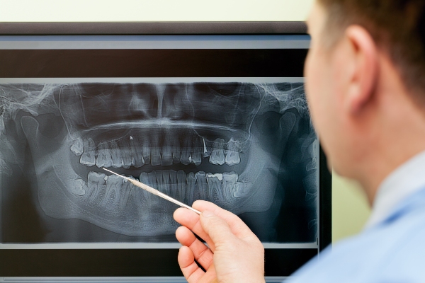 Reasons You May Need A Dental Filling