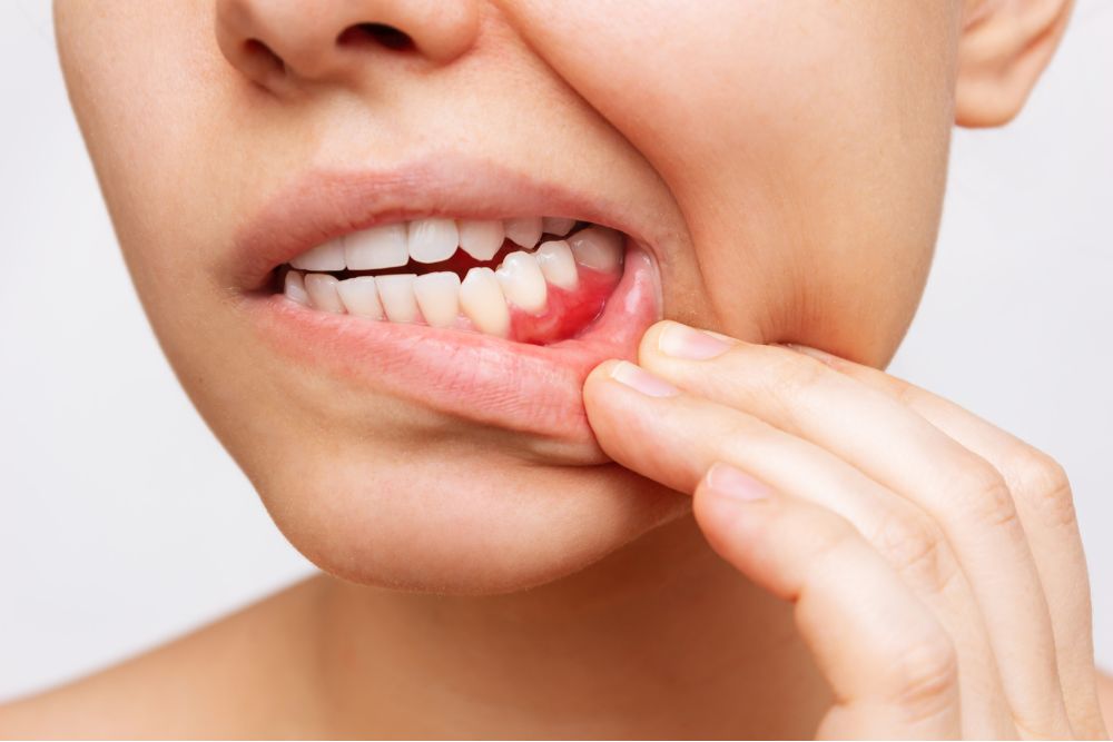 Close-up of inflamed gums and tooth pain, illustrating need for dental care and gum treatment