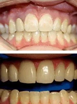Before-and-after teeth whitening comparison showing yellowed teeth improved to a brighter, more even shade.