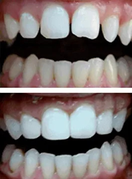 Before-and-after teeth whitening showing improved brightness and more uniform, whiter teeth.
