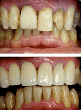 Before-and-after dental cleaning showing plaque buildup and misalignment improved to cleaner, more even teeth.