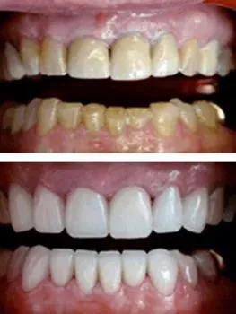 Before-and-after teeth whitening comparison showing heavy staining improved to bright, even white teeth.