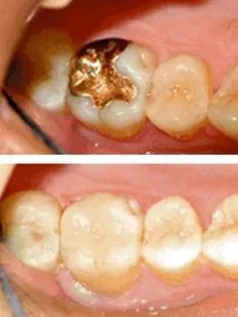 Before-and-after dental treatment showing decayed molars restored to cleaner, healthier-looking teeth.