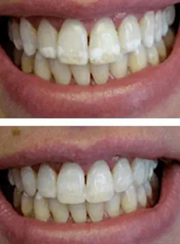 Before-and-after smile comparison showing teeth whitening with reduced yellowing and a brighter, more even appearance.